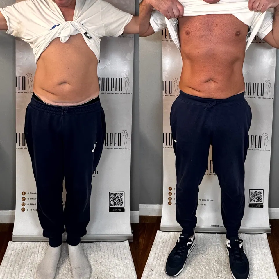 Combined before and after comparison of a client’s abdomen from the front, with before on the left and after on the right.