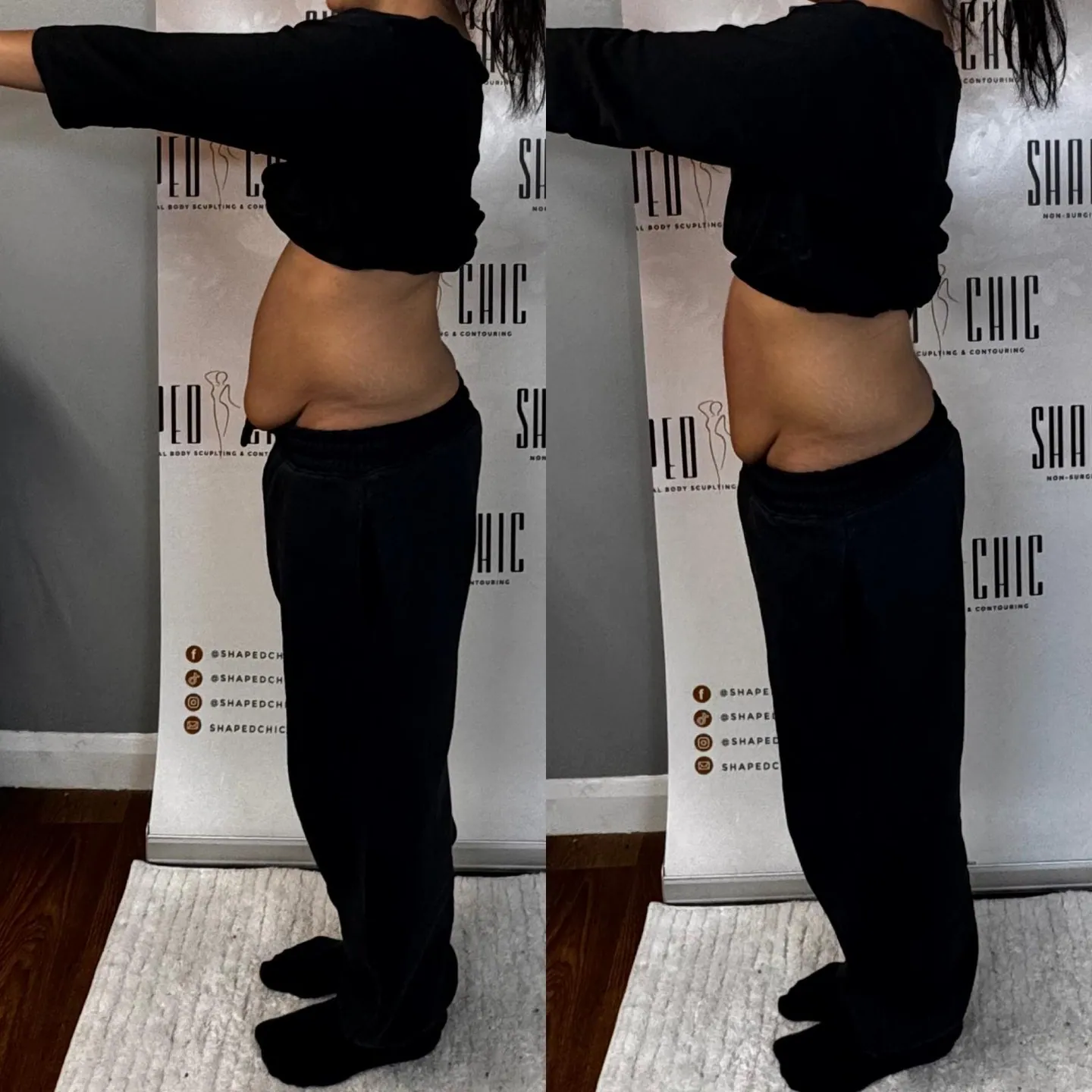 Combined before and after comparison of a client’s abdomen from the side, with before on the left and after on the right.