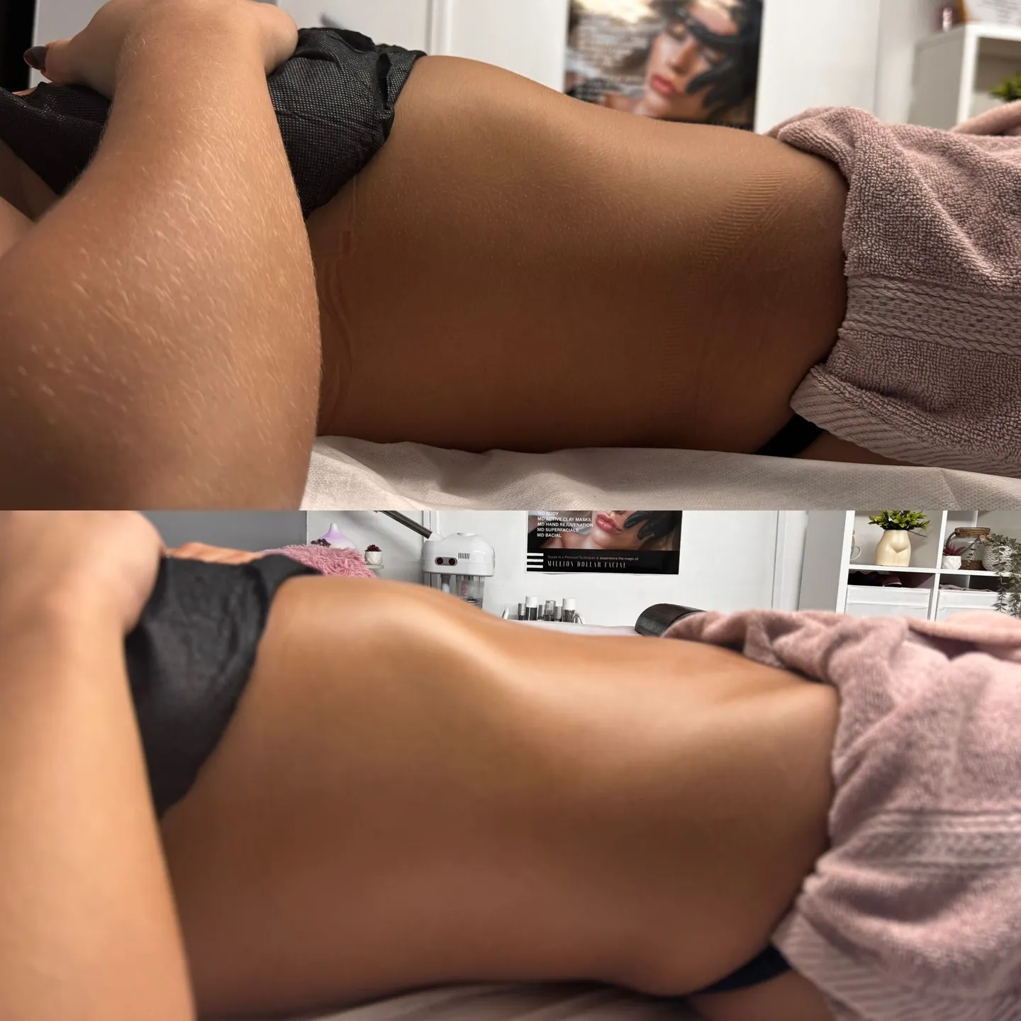 Combined before and after comparison of a client’s waist and flank area from the side, with before above and after below.