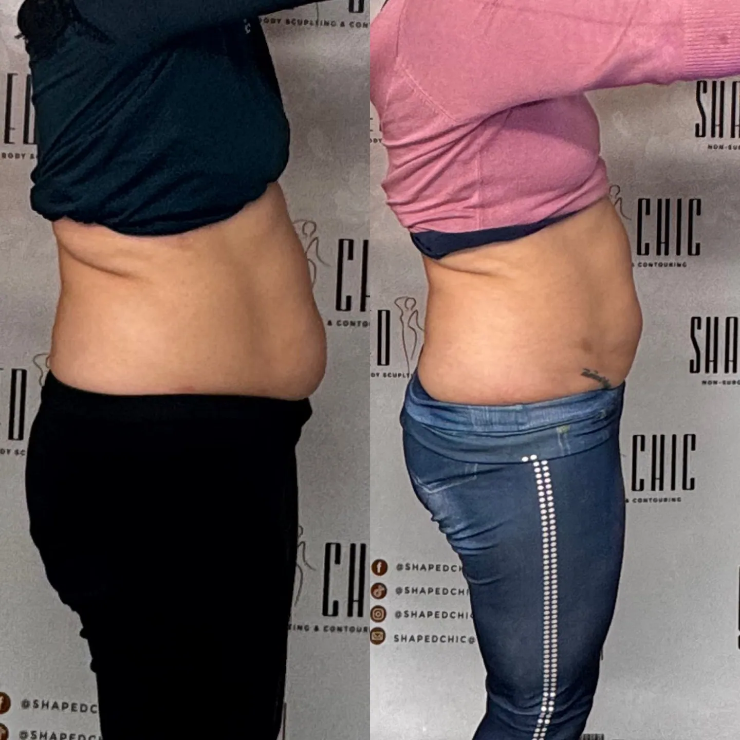Combined before and after comparison of a client’s abdomen from the side, with before on the left and after on the right.