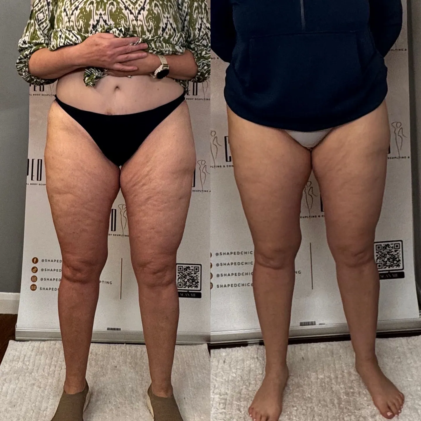 Combined before and after comparison of a client’s thighs from the front, with before on the left and after on the right.