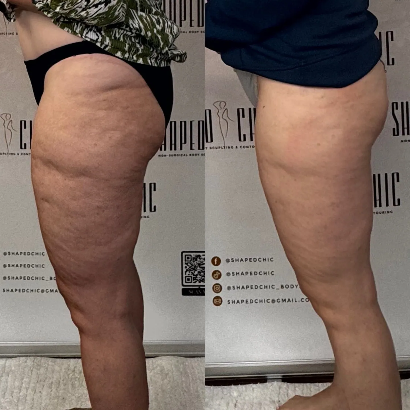 Combined before and after comparison of a client’s thigh from the side, with before on the left and after on the right.