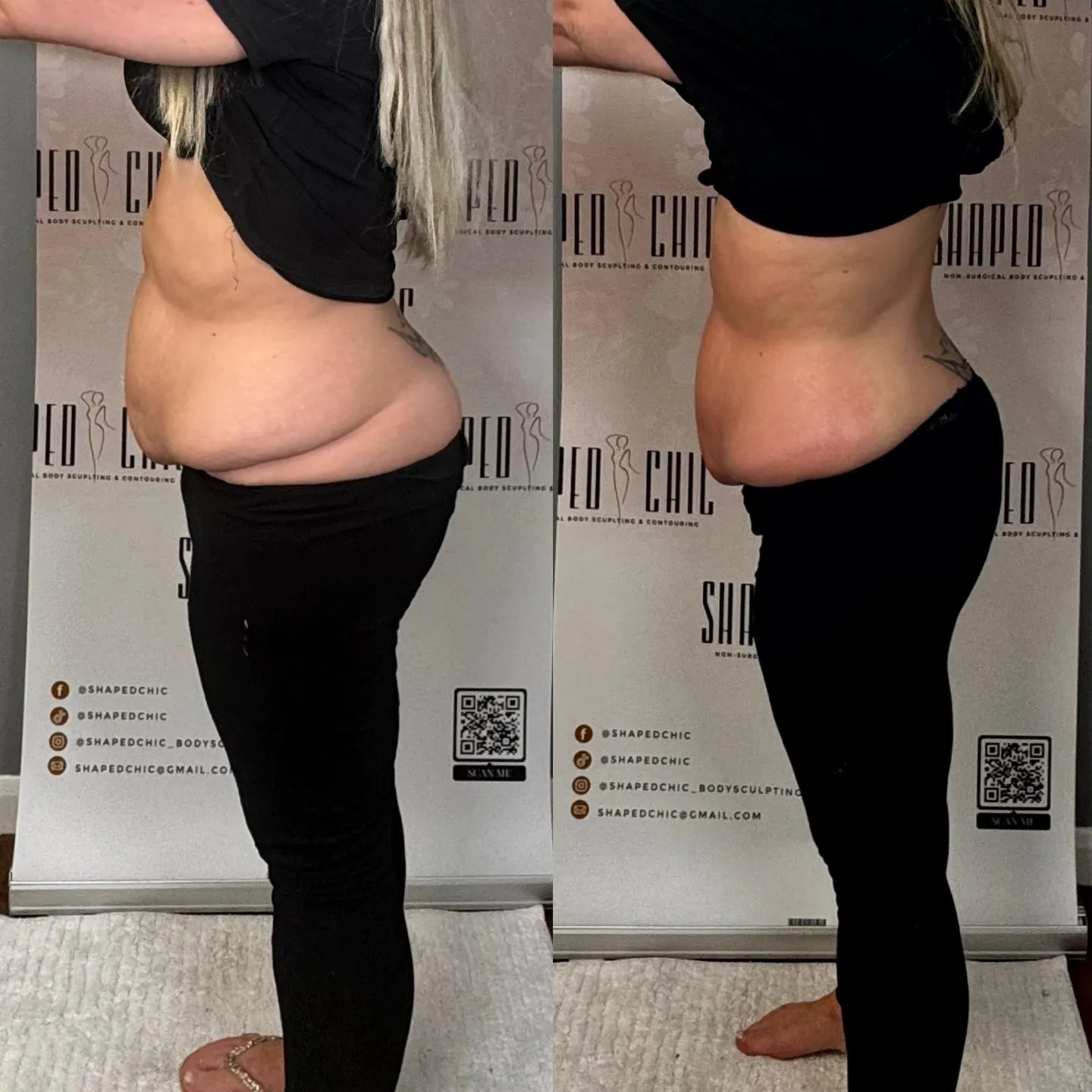 Combined before and after comparison of a client’s abdomen and waist from the side, with before on the left and after on the right.
