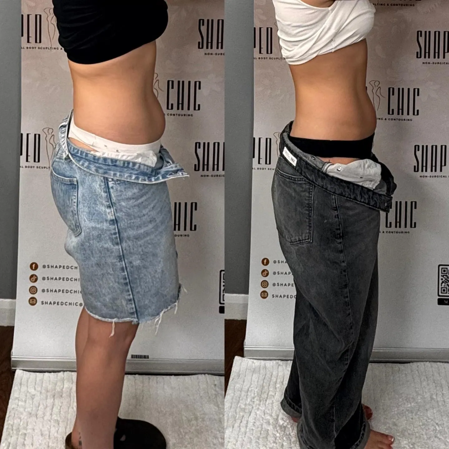 Combined before and after comparison of a client’s abdomen and waist from the side, with before on the left and after on the right.